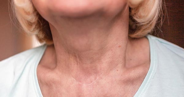 Closeup photo of an elder woman's neck after thyroid surgery